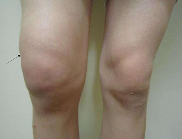 Two knees, one severely swelled