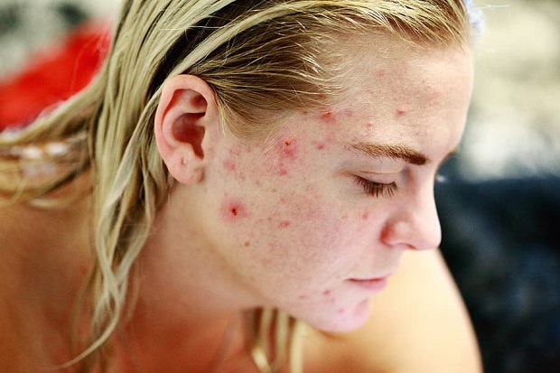 Severe acne on the cheek of a teenage girl