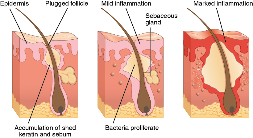 Diagram of an inflamed hair follicle 