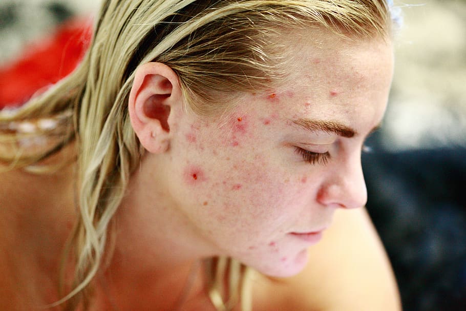 A woman with acne on her face