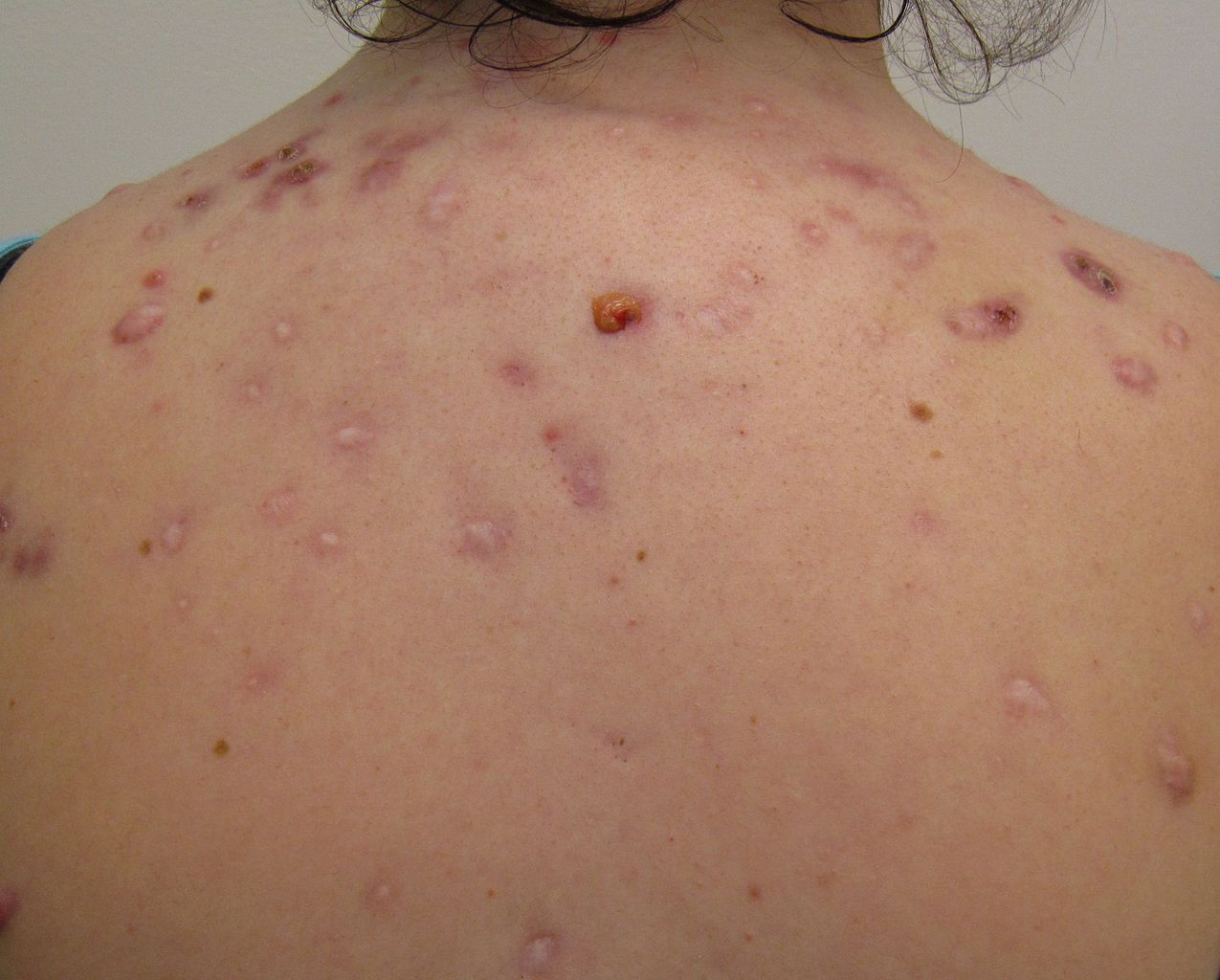 A woman with acne on her back
