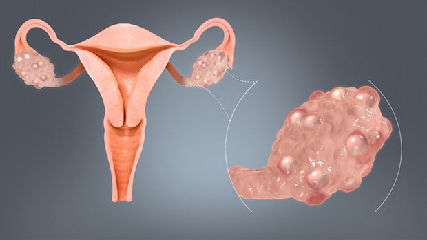 A diagram of the small sacs on the ovaries caused by PCOS